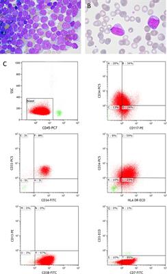 Broad genomic workup including optical genome mapping uncovers a DDX3X: MLLT10 gene fusion in acute myeloid leukemia